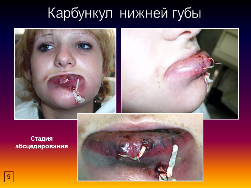 Карбункул нижней губы Стадия абсцедирования 9